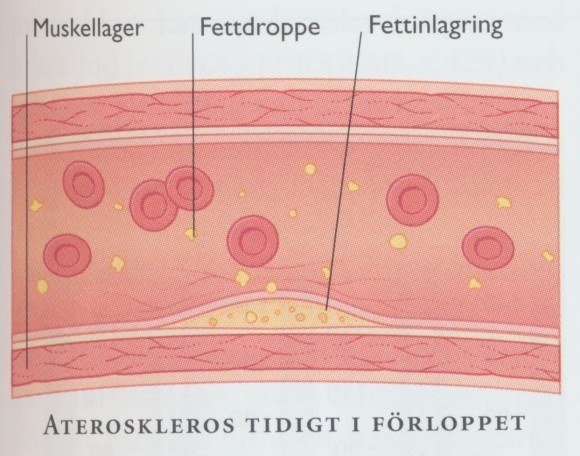 triglycerid orsakad ateroskleros